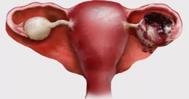 suspiciune de apoplexie ovariană carte de acuitate vizuală